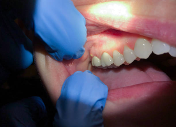 Best Emergency Dental Care for Sports Injuries in Cedar Glen Lakes, NJ